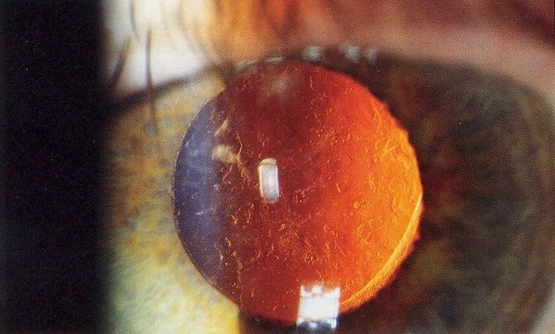 Clinical eye photograph illustrating Light Adjustable Lens