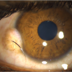 Clinical eye photograph illustrating Limbal Dermoid