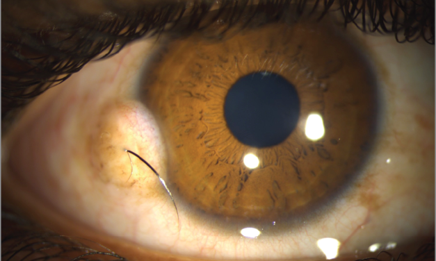 Limbal Dermoid: A Congenital Choristoma Discovered the Moment It’s Noticed