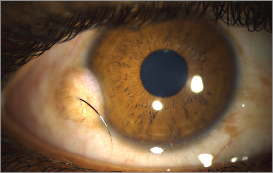 Clinical eye photograph illustrating Limbal Dermoid