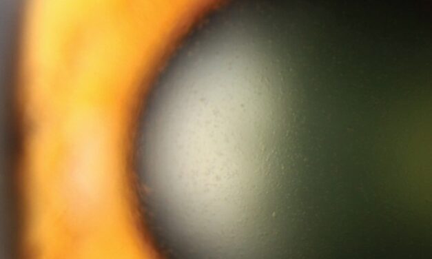 Lisch Epithelial Corneal Dystrophy: Band-Shaped Microcysts in a Clear Cornea