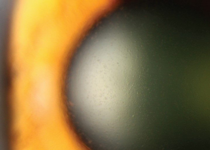 Clinical eye photograph illustrating Lisch Epithelial Corneal Dystrophy