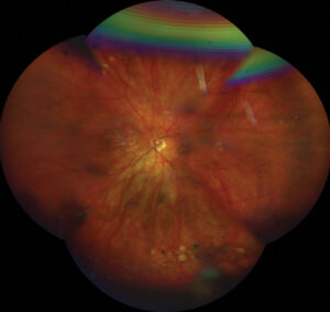 Clinical eye photograph illustrating Low Dose Atropine Myopia Control