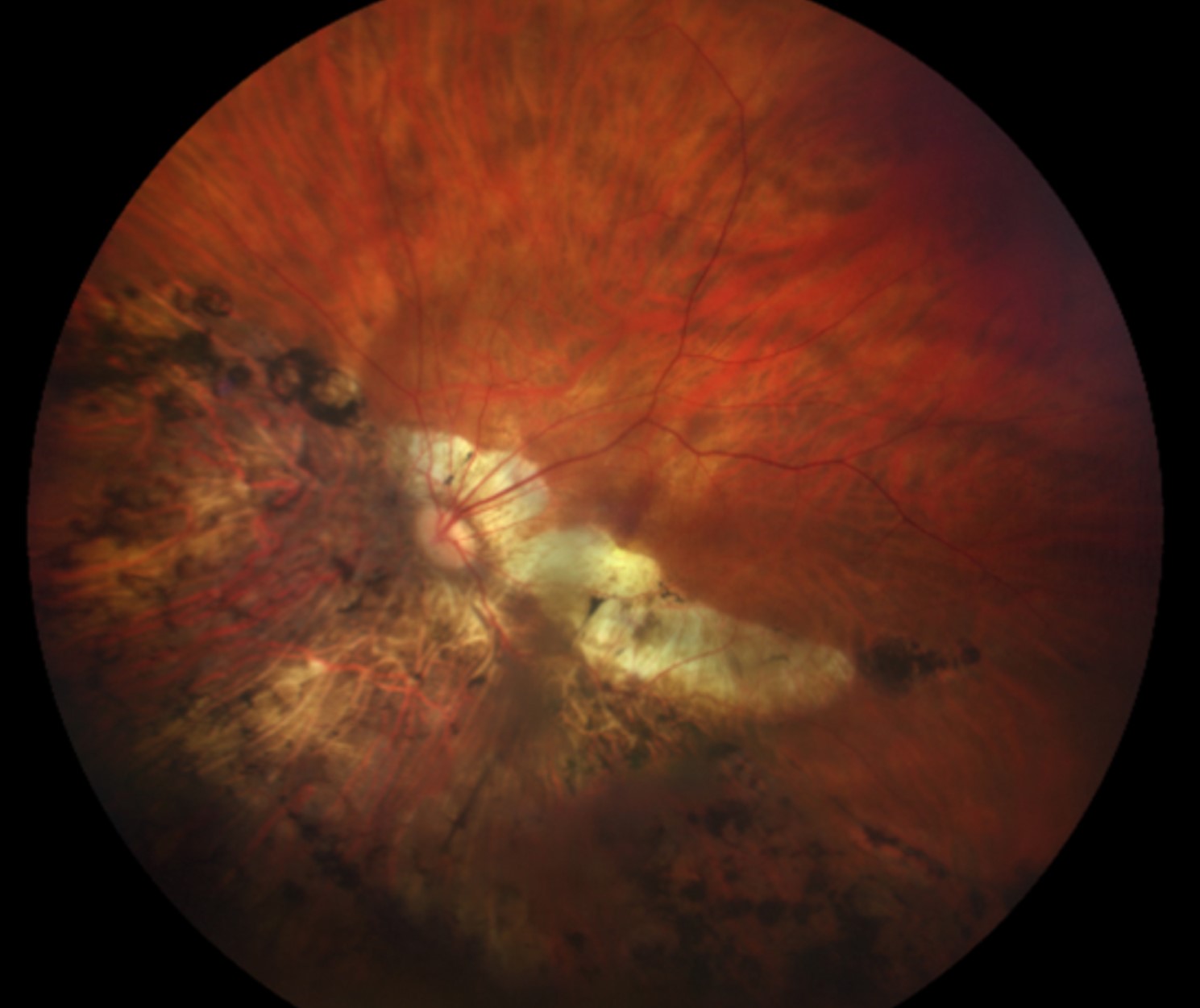 Clinical eye photograph illustrating Low Dose Atropine Myopia Control