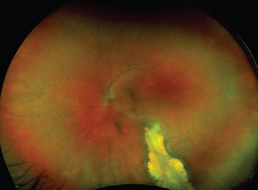 Clinical eye photograph illustrating Lyme Disease Ocular Manifestations