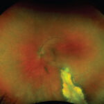 Clinical eye photograph illustrating Lyme Disease Ocular Manifestations