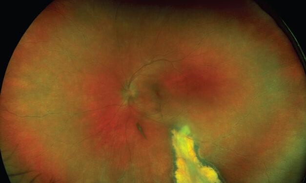 Ocular Lyme Disease: From Follicular Conjunctivitis to Uveitis and Neuroretinitis