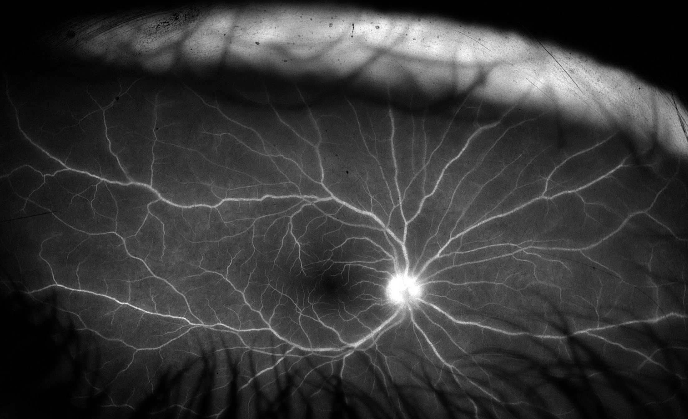 Clinical eye photograph illustrating Lyme Disease Ocular Manifestations