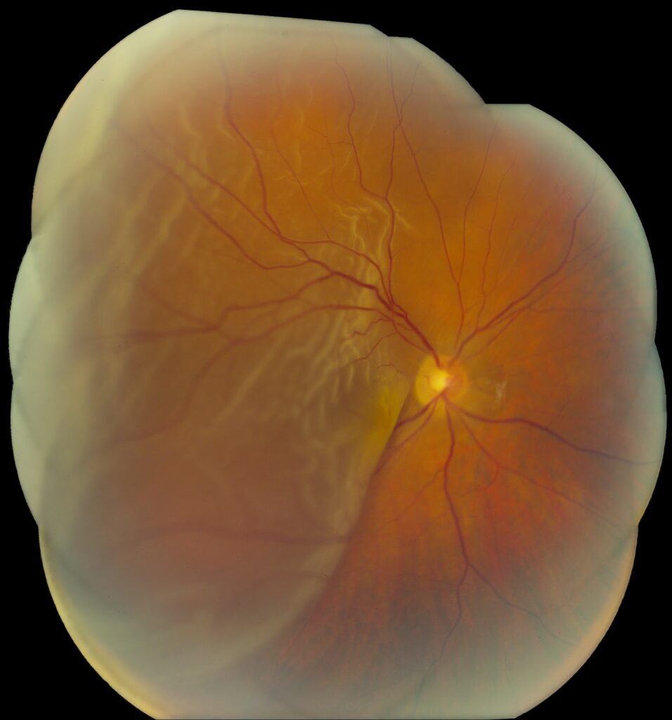 Clinical eye photograph illustrating Macula Off Retinal Detachment