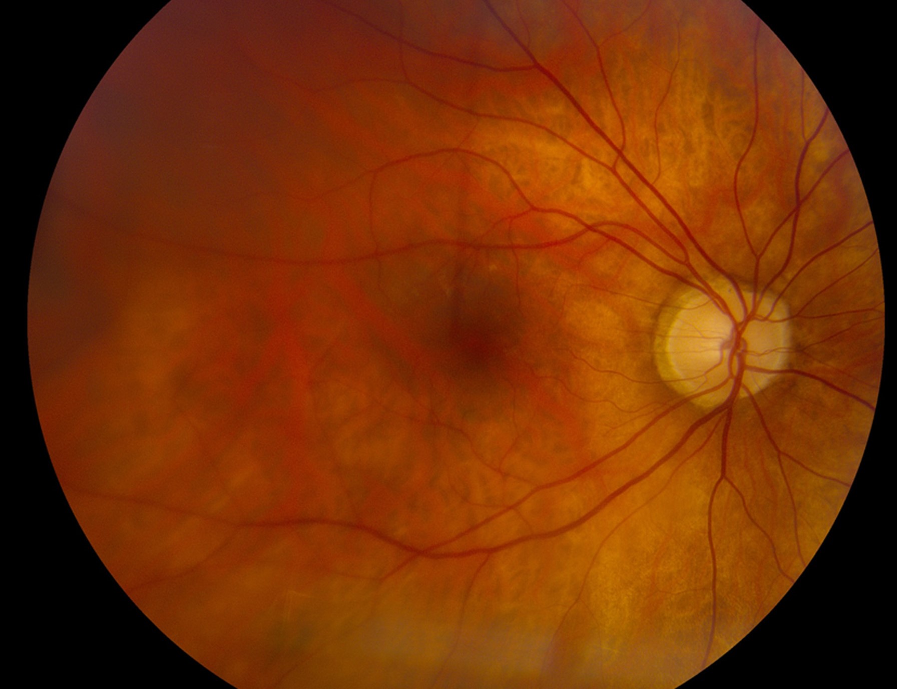 Clinical eye photograph illustrating Macula Off Retinal Detachment