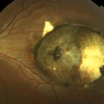Clinical eye photograph illustrating Macular Coloboma