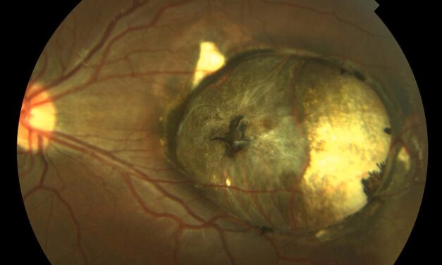 Macular Coloboma: The Punched-Out Central Lesion and the Diseases It Imitates