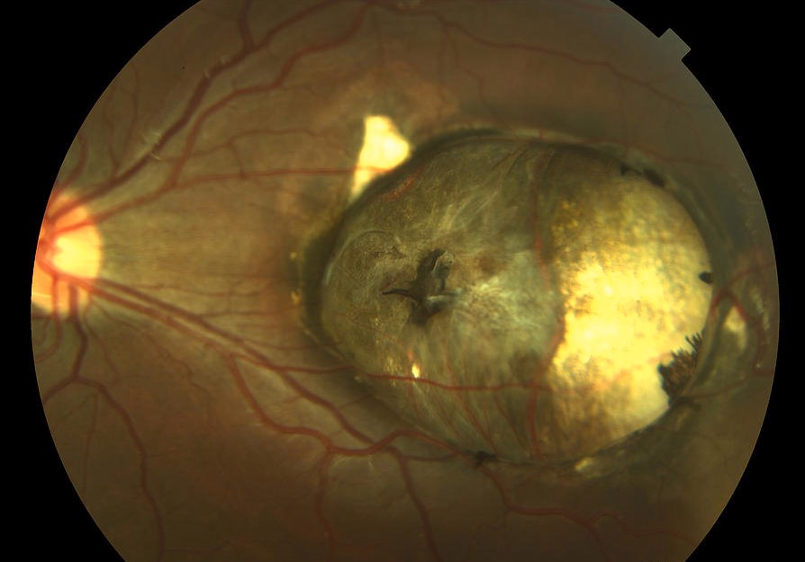 Clinical eye photograph illustrating Macular Coloboma