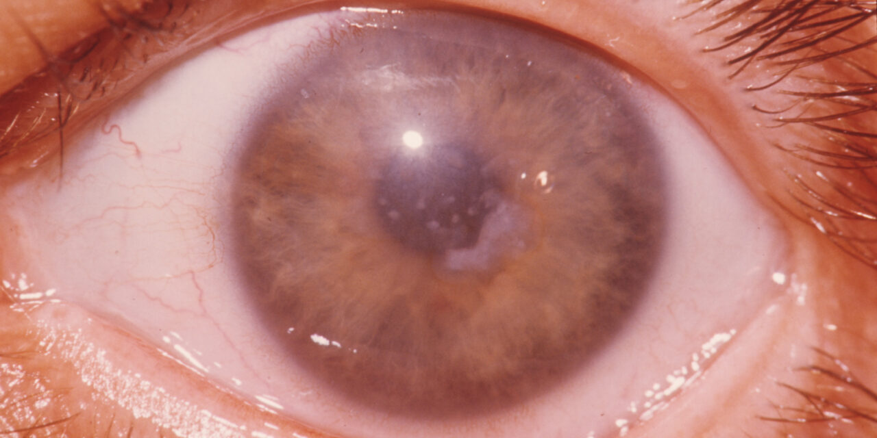 Macular Corneal Dystrophy: The Cloudy Stroma That Reaches the Limbus