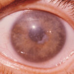 Clinical eye photograph illustrating Macular Corneal Dystrophy Systemic