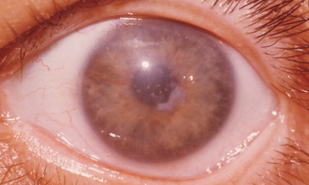 Macular Corneal Dystrophy: The Cloudy Stroma That Reaches the Limbus
