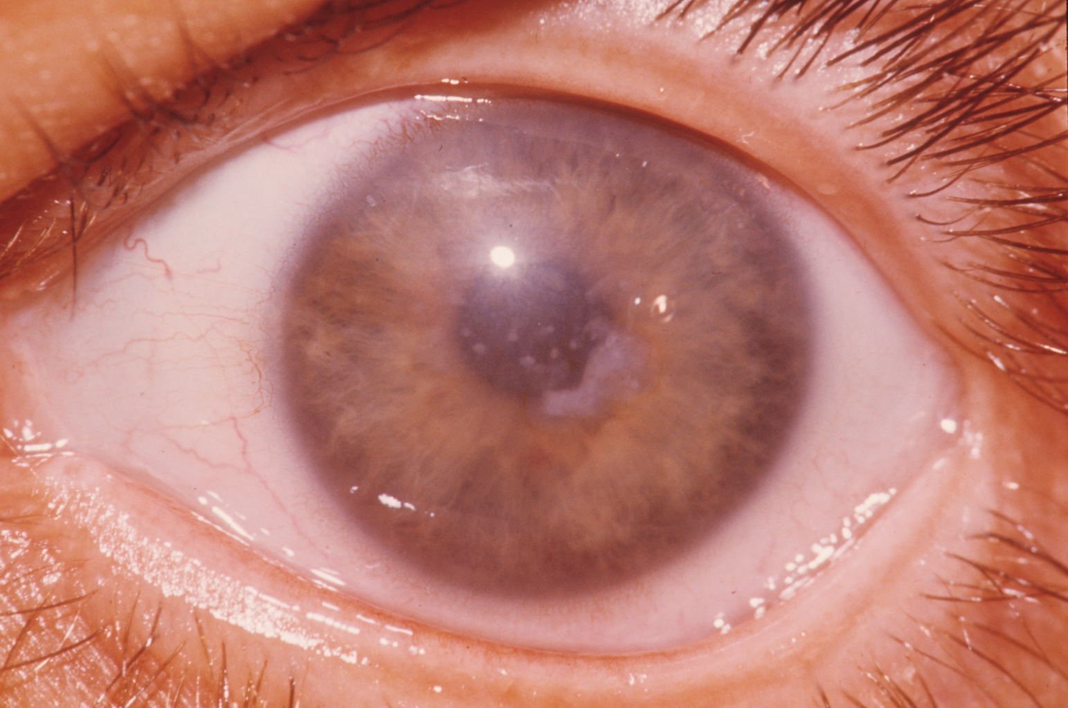Clinical eye photograph illustrating Macular Corneal Dystrophy Systemic