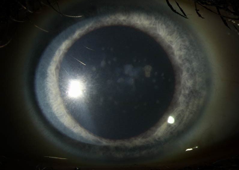 Clinical eye photograph illustrating Macular Corneal Dystrophy Systemic