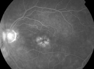 Clinical eye photograph illustrating Macular Edema After Retinal Detachment Surgery