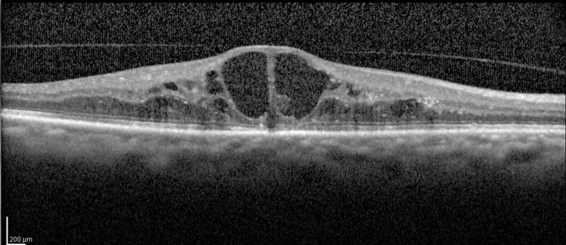 Clinical eye photograph illustrating Macular Edema After Retinal Detachment Surgery
