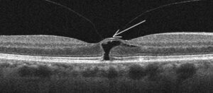Clinical eye photograph illustrating Macular Edema Causes