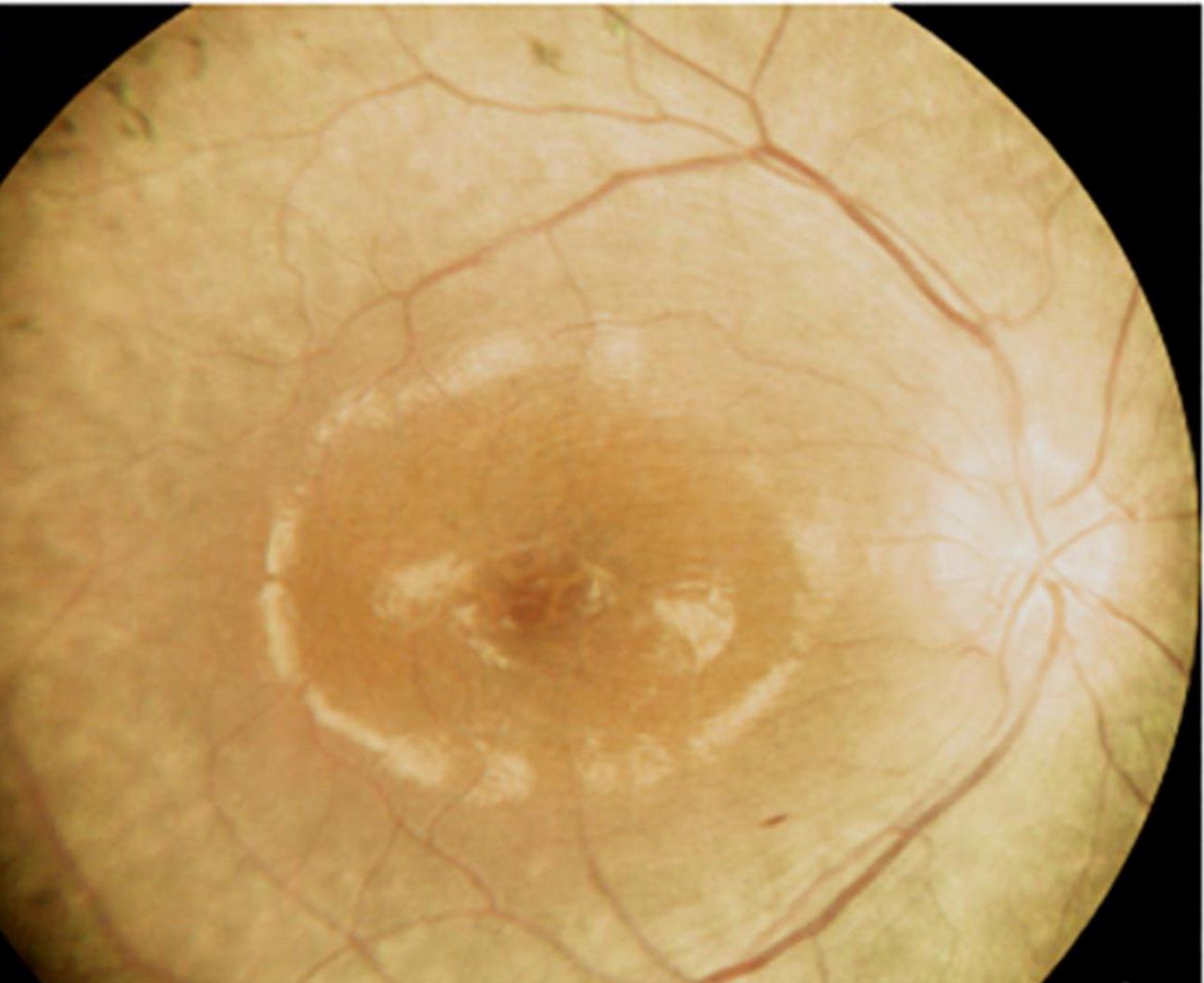 Clinical eye photograph illustrating Macular Edema Causes