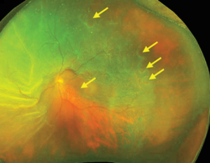 Clinical image illustrating Macular Hole Retinal Detachment in High Myopia