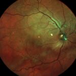 Clinical eye photograph illustrating Macular Pucker Recurrence After Peeling