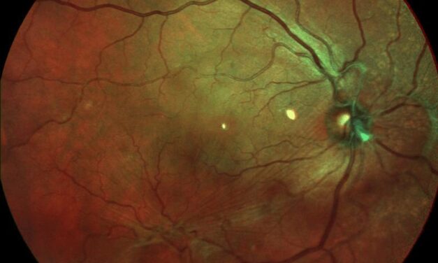 Macular Pucker Recurrence: What Actually Happens After Peeling an Epiretinal Membrane