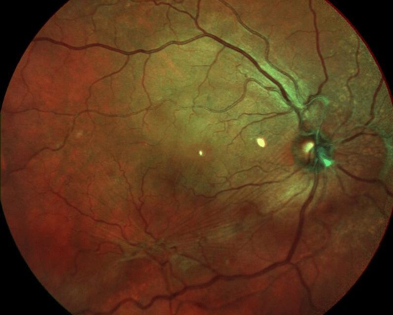 Macular Pucker Recurrence: What Actually Happens After Peeling an Epiretinal Membrane
