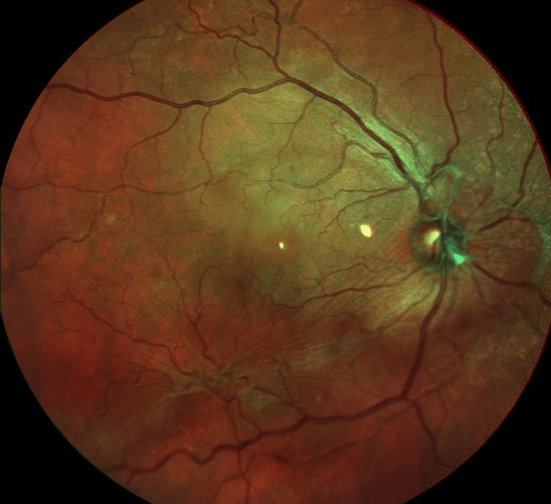 Clinical eye photograph illustrating Macular Pucker Recurrence After Peeling