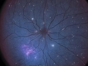 Clinical image illustrating Macular Star (Star Exudates) (figure 1)