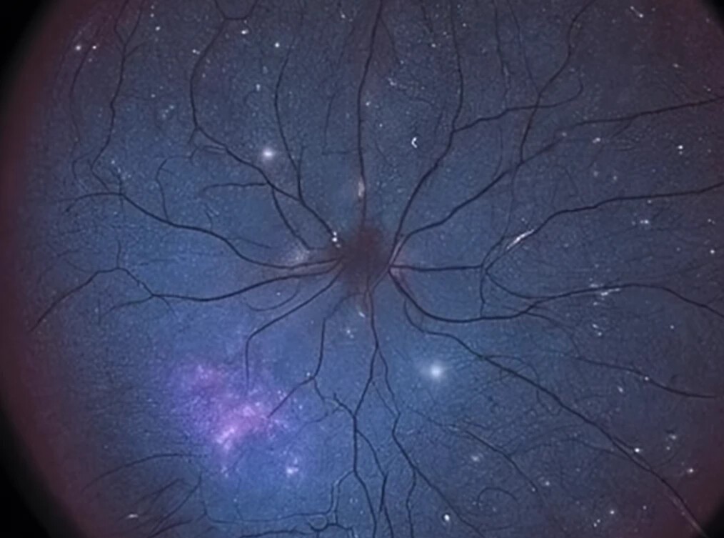 Clinical image illustrating Macular Star (Star Exudates) (figure 1)