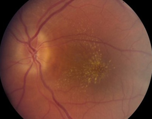 Clinical image illustrating Macular Star (Star Exudates) (figure 2)