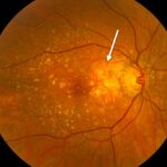 Clinical eye photograph illustrating Macular Translocation Rotating the Fovea