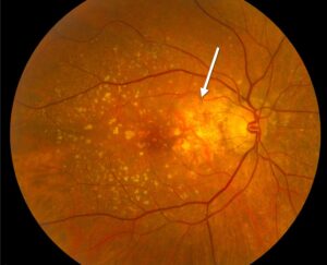Clinical eye photograph illustrating Macular Translocation Rotating the Fovea