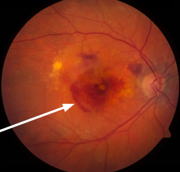 Clinical eye photograph illustrating Macular Translocation Rotating the Fovea