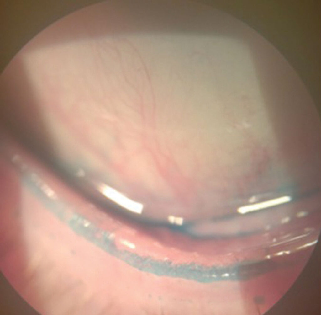 Clinical eye photograph illustrating Marx Line Lid Margin