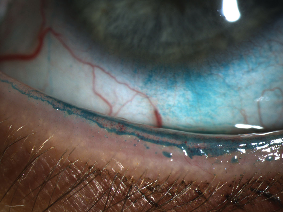 Clinical eye photograph illustrating Marx Line Lid Margin
