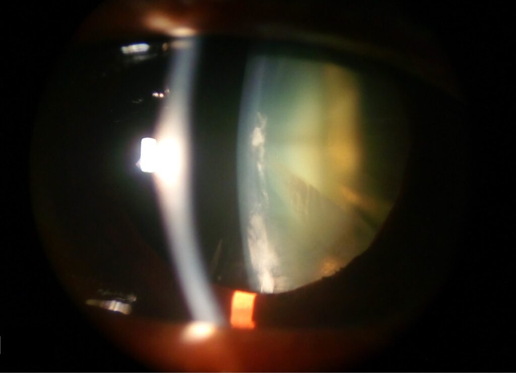 Clinical eye photograph illustrating Membranous Cataract