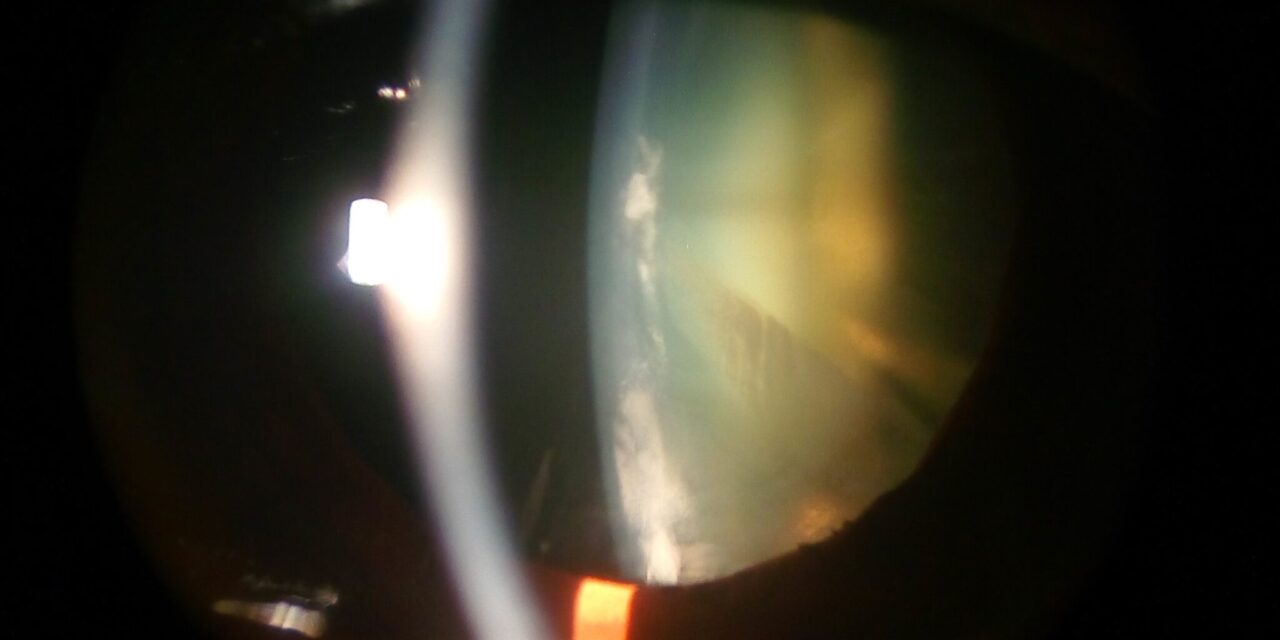 Membranous Cataract: When Lens Matter Is Resorbed and Only a Thin Sheet Is Left