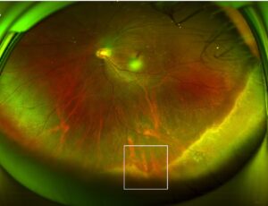 Clinical eye photograph illustrating Meridional Folds Benign Peripheral Retina
