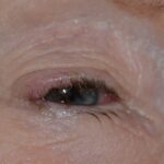 Clinical eye photograph illustrating Merkel Cell Carcinoma Eyelid