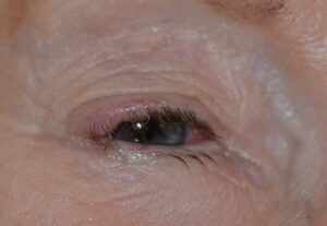 Clinical eye photograph illustrating Merkel Cell Carcinoma Eyelid