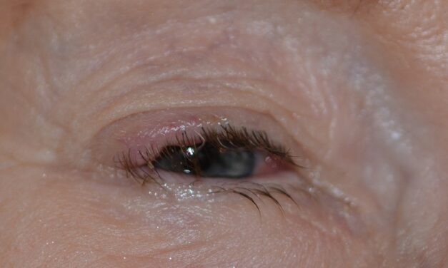 Merkel Cell Carcinoma of the Eyelid: The Rapidly Growing Violaceous Nodule That Mimics a Chalazion