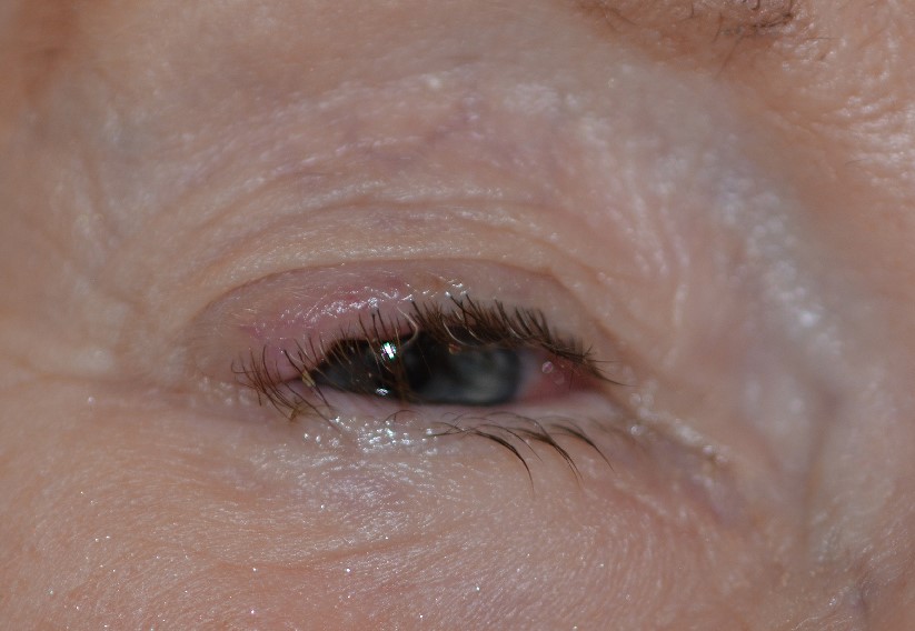 Clinical eye photograph illustrating Merkel Cell Carcinoma Eyelid