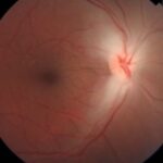 Clinical eye photograph illustrating Methanol Optic Neuropathy