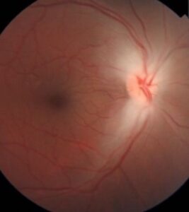 Clinical eye photograph illustrating Methanol Optic Neuropathy