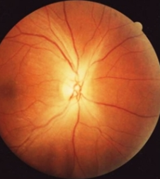 Clinical eye photograph illustrating Methanol Optic Neuropathy