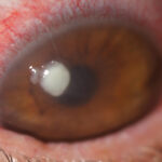 Clinical eye photograph illustrating Microbial Keratitis Risk Factors